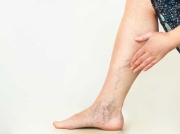 Варикоз вен на ногах – избежать или лечить?