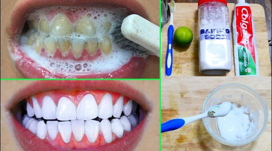 Почему нельзя отбеливать зубы в домашних условиях