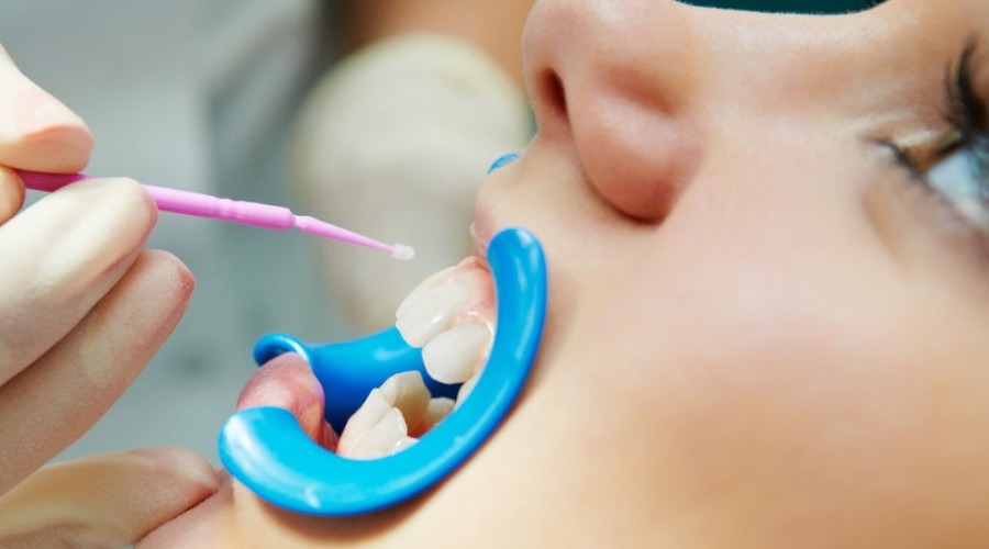 Фторирование зубов, как способ профилактики развития кариеса