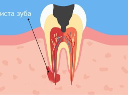 Киста зуба. Как от нее избавиться?