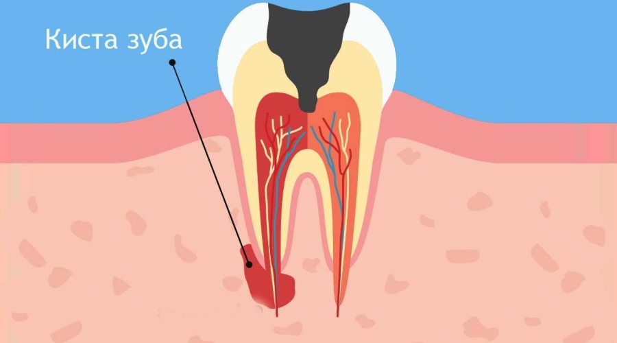 Киста зуба. Как от нее избавиться?