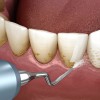 От чего образуются камни на зубах?