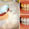 Можно ли отбелить зубы перекисью водорода?