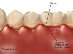 Как лечить гингивит