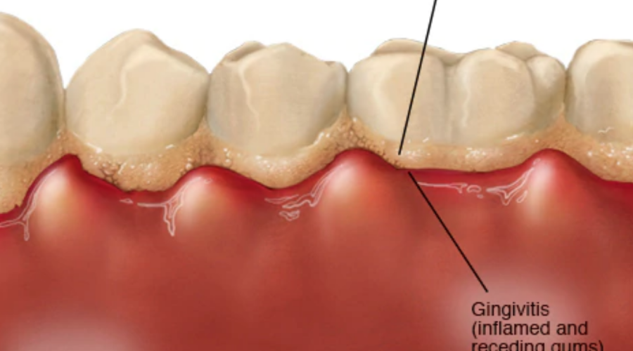 Как лечить гингивит