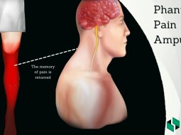 Как избавиться от фантомных болей. После ампутации.