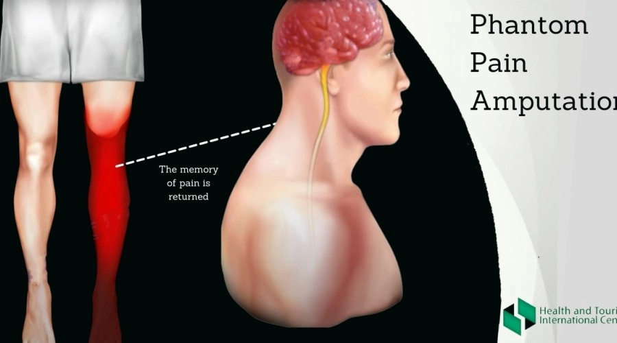 Как избавиться от фантомных болей. После ампутации.
