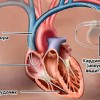 Как работает кардиостимулятор?