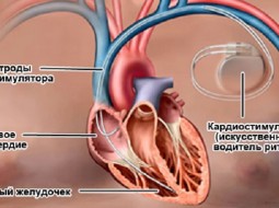 Как работает кардиостимулятор?