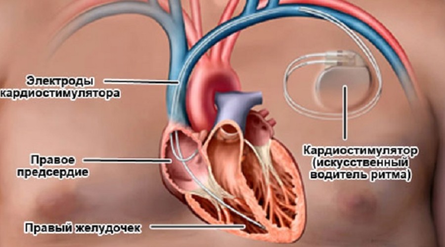 Как работает кардиостимулятор?