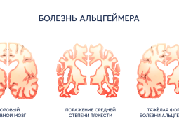 Новый способ лечения болезни Альцгеймера. 