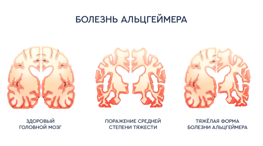 Новый способ лечения болезни Альцгеймера. 