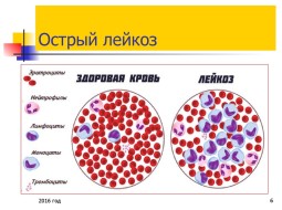 Что такое острый лейкоз