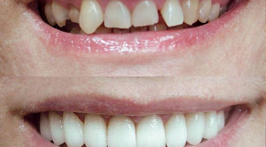 Как наращивают передние зубы?