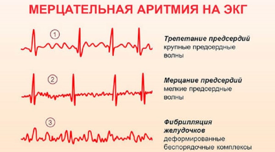 Что нужно знать о мерцательной аритмии