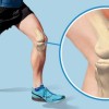 Почему возникают боли в коленях после бега, методы их лечения
