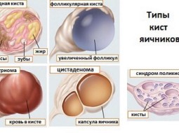 Какие бывают виды кист яичников