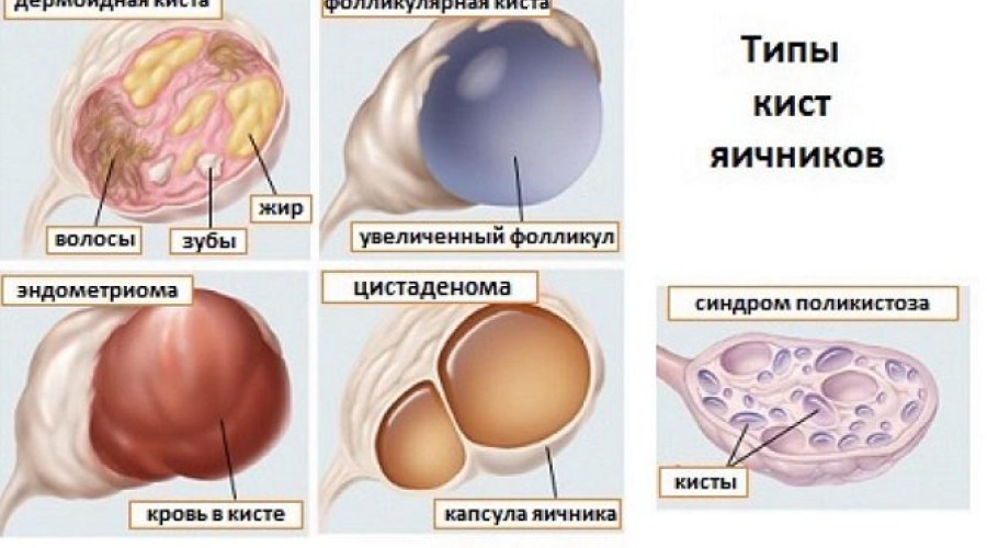 Какие бывают виды кист яичников