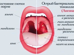 Как лечить фарингит у детей