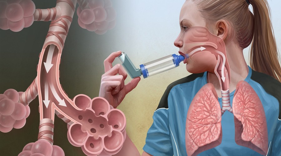 Бронхиальная астма: как побороть обострение?