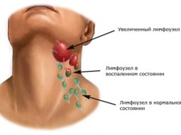 От чего могут воспалиться лимфоузлы под челюстью?
