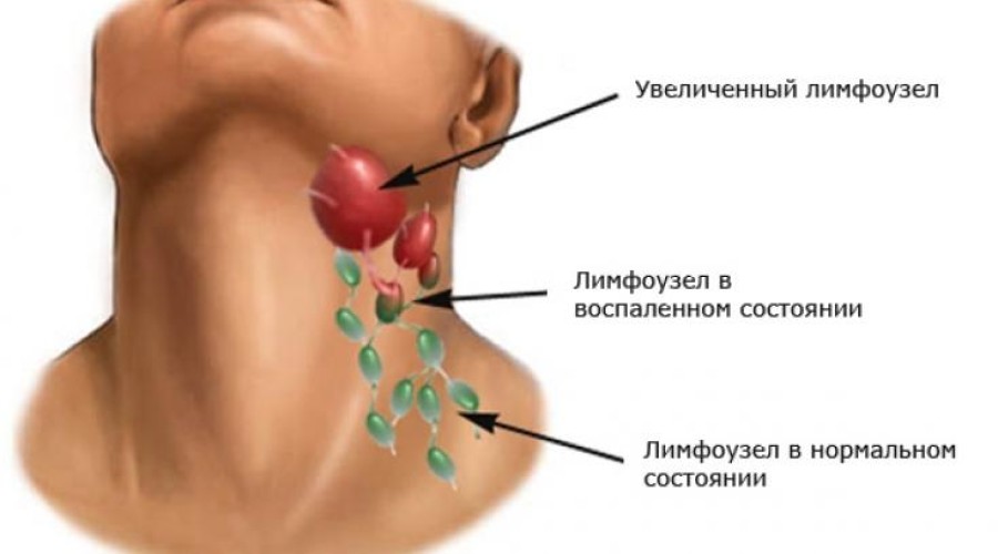 От чего могут воспалиться лимфоузлы под челюстью?