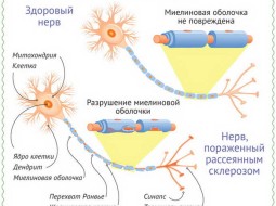 Как лечить рассеянный склероз: основные принципы терапии