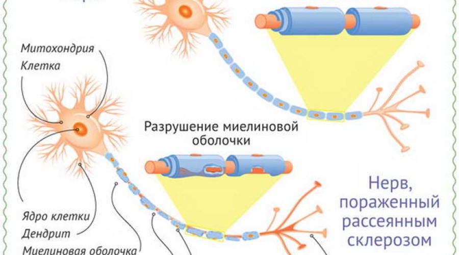 Как лечить рассеянный склероз: основные принципы терапии
