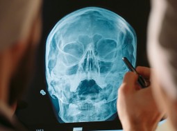  Зачем нужен рентген черепа? 
