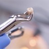 Чем можно остановить кровь после удаления зуба?