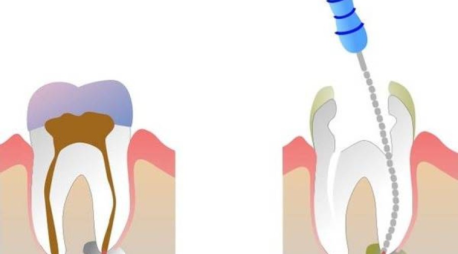Можно ли убить зубной нерв укусом?