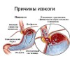 Как определить чем вызвана изжога и избавиться от нее