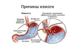 Как определить чем вызвана изжога и избавиться от нее