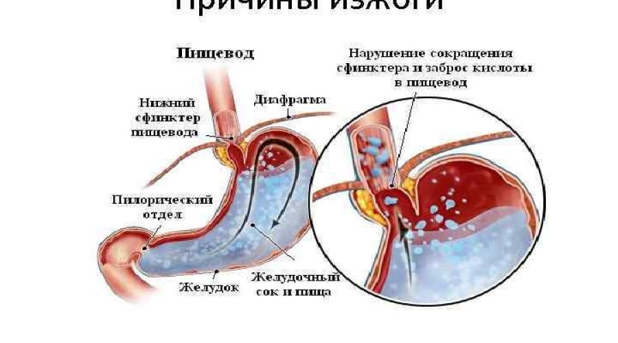 Как определить чем вызвана изжога и избавиться от нее