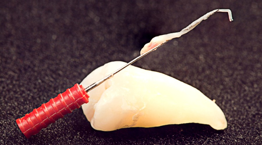 Как происходит удаление нерва зуба?
