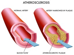 Как обнаружить и вылечить атеросклероз
