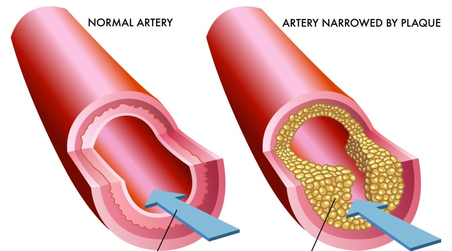 Как обнаружить и вылечить атеросклероз