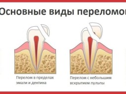 Что делать, если откололся зуб?