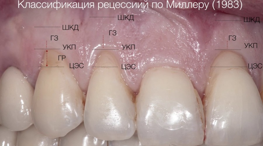 Почему опускаются десны и оголяются зубы?