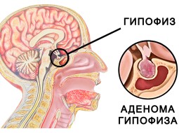 Что такое аденома гипофиза  