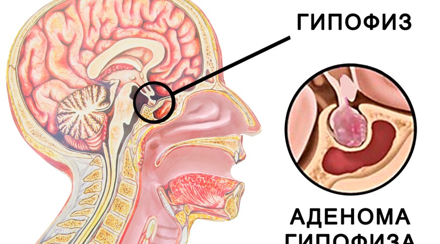 Что такое аденома гипофиза  