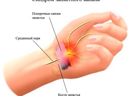 Что такое синдром запястного канала?