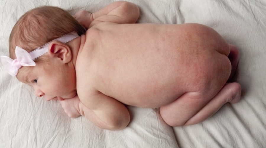 Как выглядит аллергия у новорожденных?