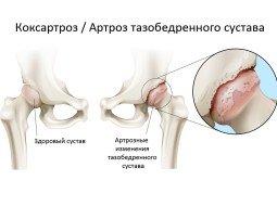 Как лечить деформирующий артроз тазобедренного сустава?