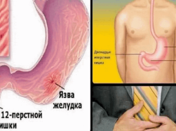 Как лечить язву желудка