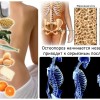 Что такое остеопороз и как его предупредить? 