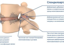 Спондилоартроз — что это?