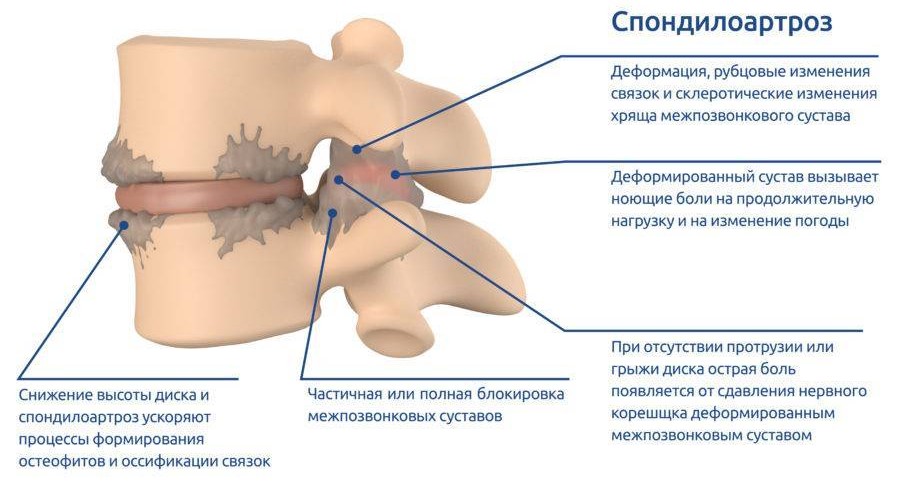 Спондилоартроз — что это?