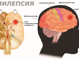 Что такое эпилепсия