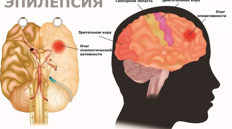 Что такое эпилепсия